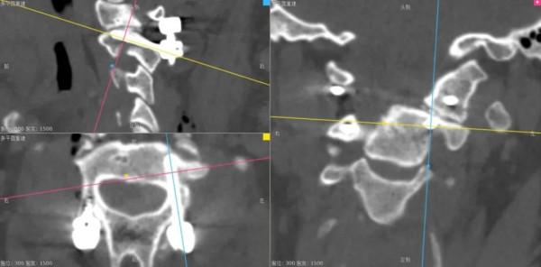 C2椎動脈高跨置釘技術之N