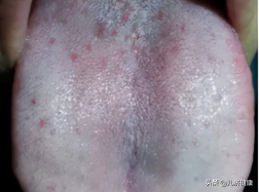 1碗湯消腫散結，最適合增生、肌瘤、囊腫的女性