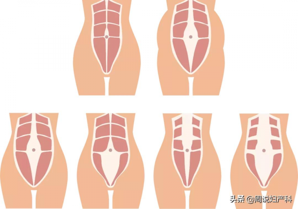 不胖卻有小肚子，當心這3個問題