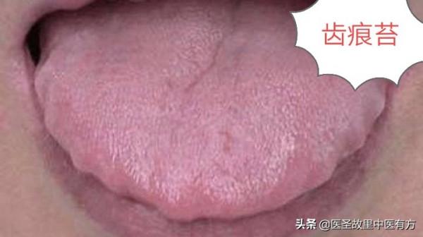 舌有裂紋，是身體有病的表現！這些中藥驗方，專治舌裂舌痛舌幹