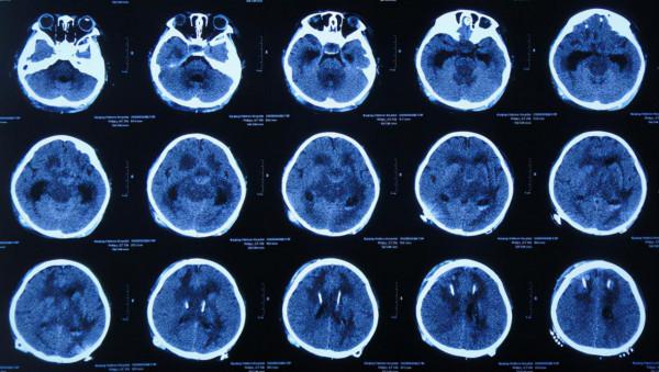 顱內生殖細胞瘤切除術後腦積水仍反覆,意識模糊,左側肢體偏癱 顱內生殖細胞瘤切除術後腦積水仍反覆,意識模糊,左側肢體偏癱