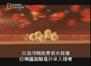 3年讓血管斑塊縮小近50%，這是如何做到的？2個關鍵點