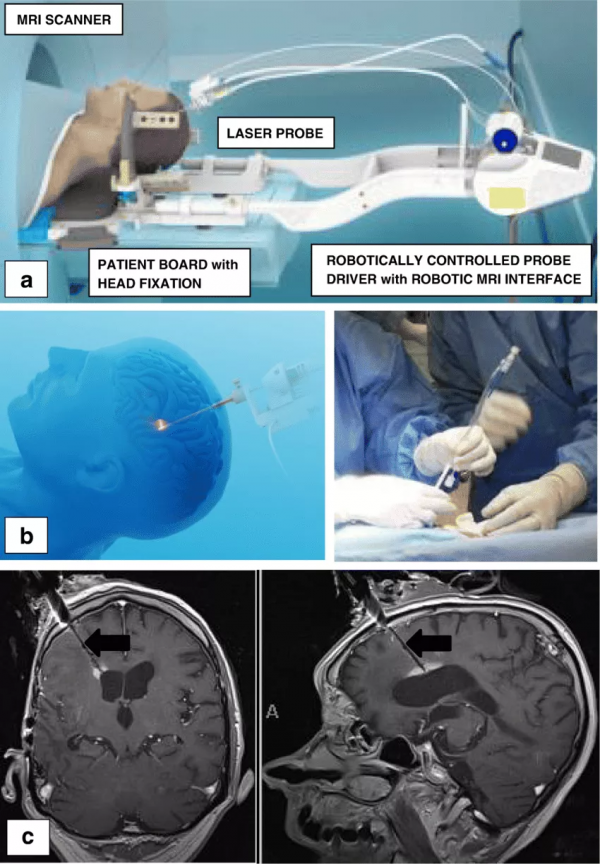 不用開顱的LITT鐳射間質熱療，治腦瘤真的有效嗎？最新臨床資料