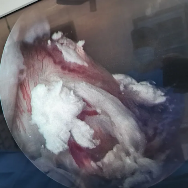 關節紅腫熱痛，醫生竟刮下一層&OpenCurlyDoubleQuote;雪花&rdquo;