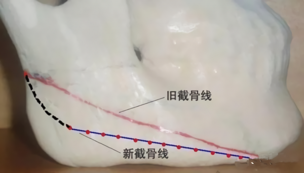 那些“一刀切”削臉的明星還好嗎？有的已垮掉，小方臉成最後贏家