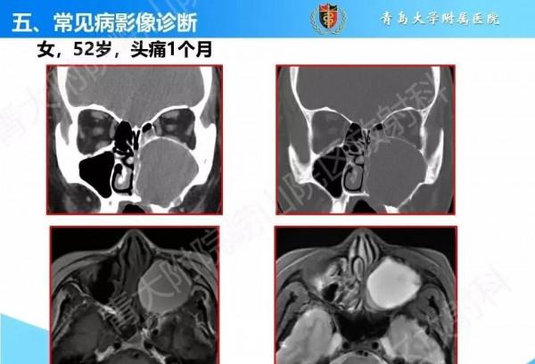 頭頸五官CT斷層解剖圖及常見病影像診斷