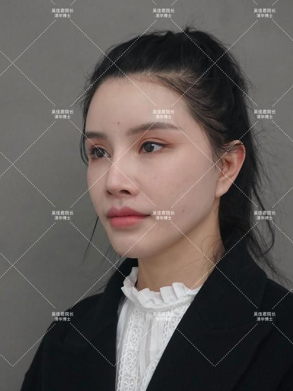 32歲姑娘小拉皮術後7個半月，變得年輕又精緻，前後反差很大