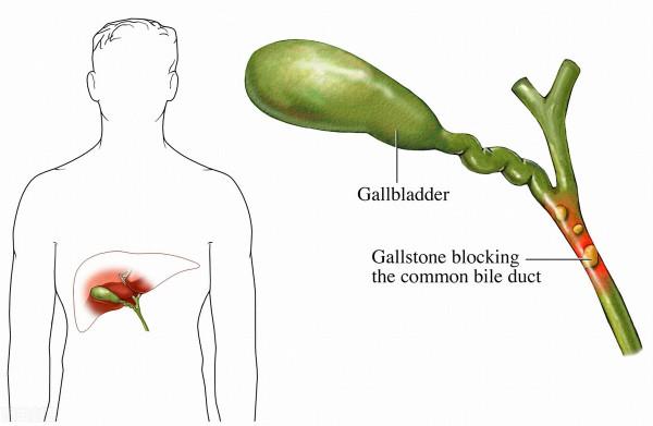 膽囊並非可有可無,切除後對身體有何影響?醫生一文解釋清楚 膽囊並非可有可無,切除後對身體有何影響?醫生一文解釋清楚