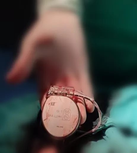 市八醫成功完成全省首例帶有核磁相容功能的雙腔ICD植入手術