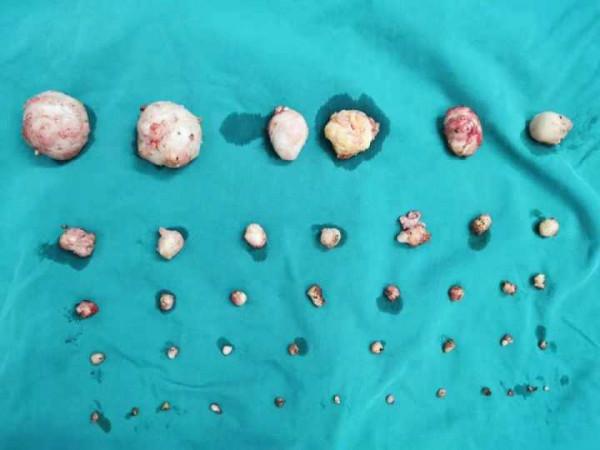 二孩媽媽子宮裡有41個肌瘤，她還能要第三個寶寶嗎？