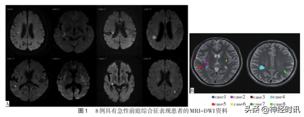 能引起眩暈的急性腦梗死