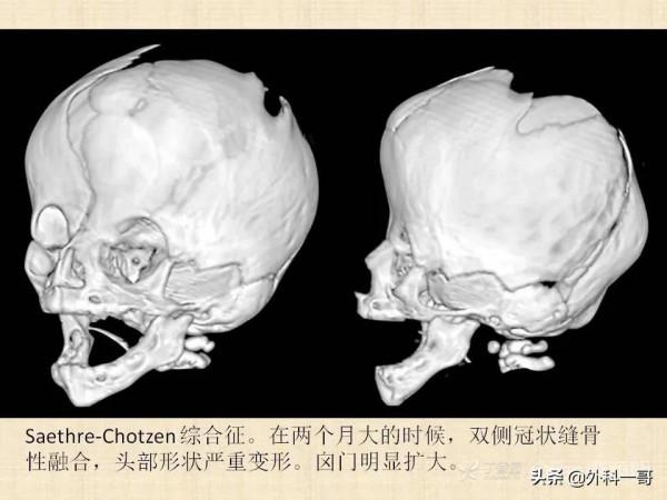 小兒顱縫早閉的診斷治療