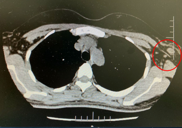 愈見未萊 | 恩美曲妥珠單抗助力HER2+早期乳腺癌患者的生存率再上新臺階