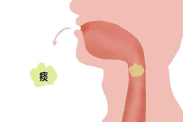 黃痰、白痰、黑痰、血性痰，分別提示什麼健康問題？痰多咋辦？