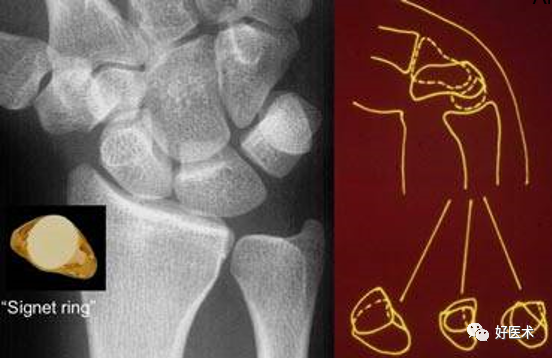 贊！腕關節X線高畫質解剖+腕骨脫位典型病例