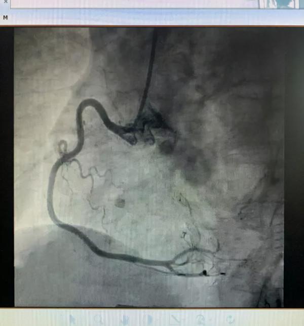 撥開異常心電圖的層層迷霧