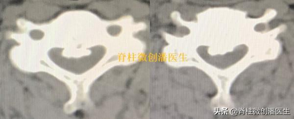 做完頸椎手術後為什麼會肩膀痛？多長時間能恢復