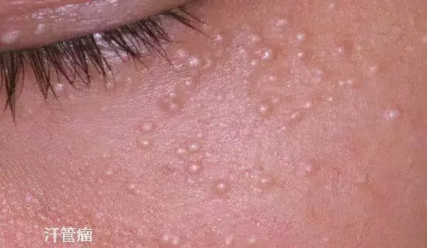 眼角凸起顆粒是瞼黃瘤還是汗管瘤~你會區分嗎？