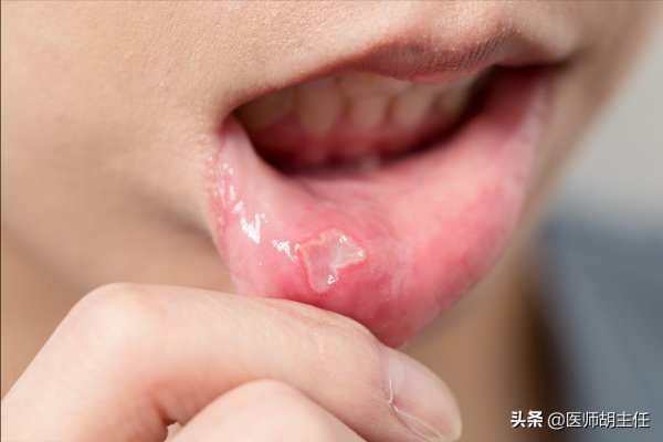 有一種痛，叫口腔潰瘍！醫生提醒：牢記這幾招，促進口腔潰瘍癒合