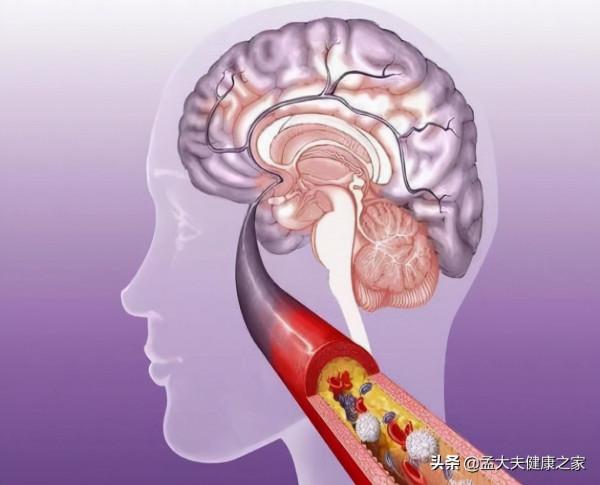 長期服用阿司匹林和他汀，是在治療腦梗死嗎，真正目的是什麼？