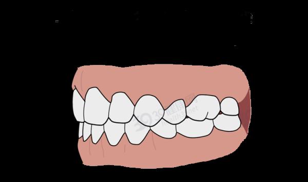 為什麼只要戴牙套,牙齒就可以恢復得很整齊?生動展示矯正過程 為什麼只要戴牙套,牙齒就可以恢復得很整齊?生動展示矯正過程