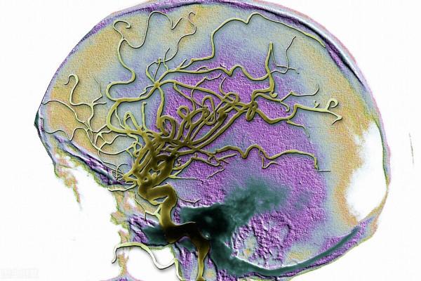 從診斷高血壓到腦出血去世,10年間這位患者經歷了什麼? 從診斷高血壓到腦出血去世,10年間這位患者經歷了什麼?