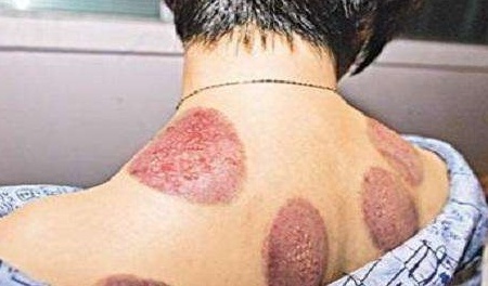 拔完罐後身上的淤青是身體排出的毒素嗎？看看老中醫是怎麼說的