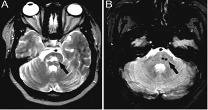 磁共振上出現腦微出血,這11種病因要考慮 磁共振上出現腦微出血,這11種病因要考慮