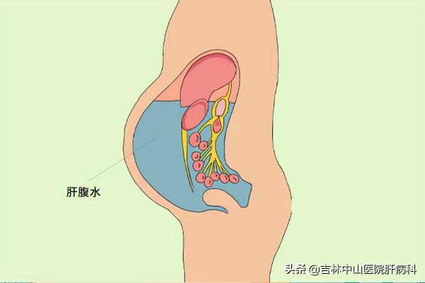 什麼是肝腹水?肝腹水的初期症狀有哪些? 什麼是肝腹水?肝腹水的初期症狀有哪些?