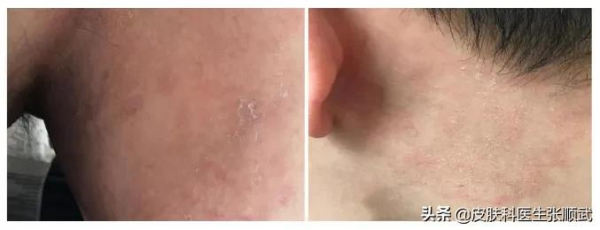 大腿根紅了一片特別癢，抹藥不好反而傳染到脖子上了