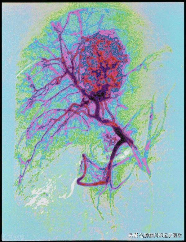 肝癌治療有了新模式，讓患者更久生存