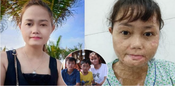 可憐!越南女子被丈夫潑油漆毀容,為了兩個孩子堅強求生 可憐!越南女子被丈夫潑油漆毀容,為了兩個孩子堅強求生