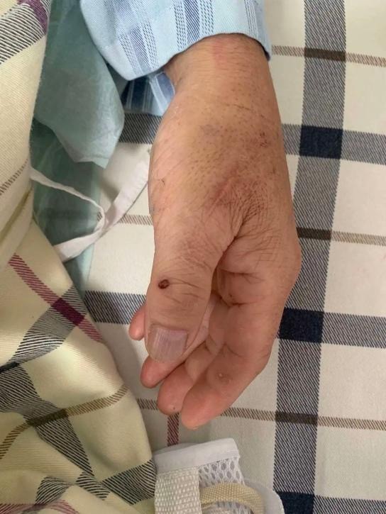 廣西女子清洗豬肉的操作,確診腦膜炎!輕則聽力喪失,重則致命 廣西女子清洗豬肉的操作,確診腦膜炎!輕則聽力喪失,重則致命