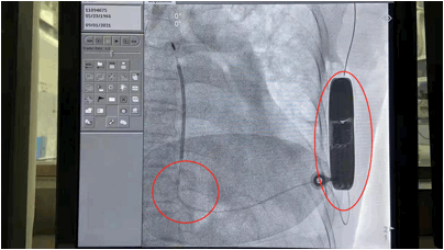 兩個小切口植入除顫器,為重度心衰患者糾正心率不齊 兩個小切口植入除顫器,為重度心衰患者糾正心率不齊