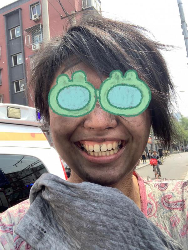 逃出火場的我十分亢奮，但接著就被塞進ICU淬火了