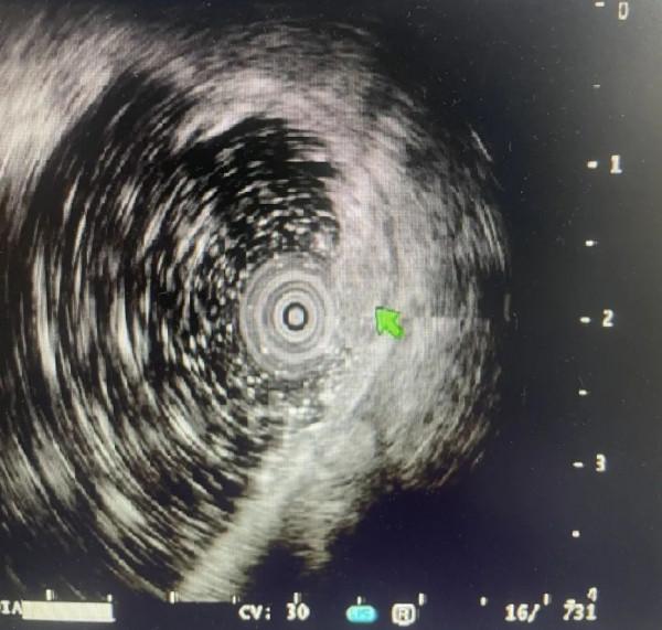 【硬實力】結腸多發側向發育型腫瘤（LST）內鏡下精準診治&mdash;&mdash;雙鏡聯合技術的再應用