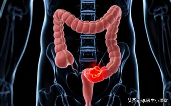 腸息肉和腸癌有什麼關係?來聽聽醫生怎麼說 腸息肉和腸癌有什麼關係?來聽聽醫生怎麼說