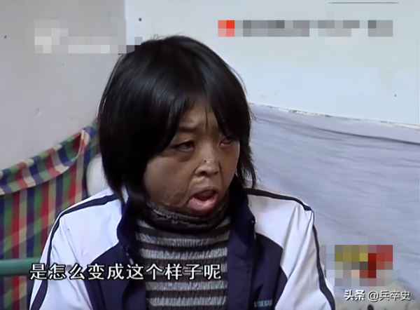 真實故事：山東女娃被開水燙成“鬼臉”，24歲結婚後又慘遭家暴