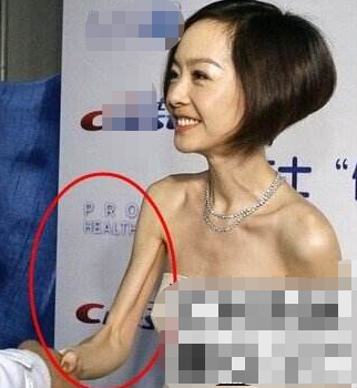 &OpenCurlyDoubleQuote;內卷&rdquo;下暴瘦的10位女星，有人瘦到22公斤，體力不支只能坐輪椅