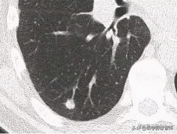 22個肺部疾病的CT徵象 22個肺部疾病的CT徵象
