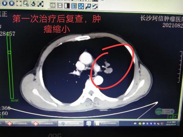 「病例分享」53歲肺鱗癌患者，出現咯血，兩週期治療後腫瘤消失