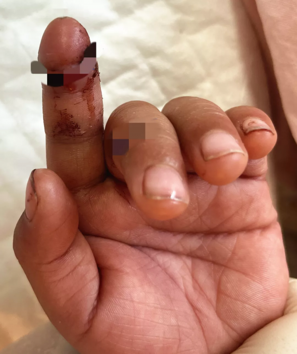 6小時徹夜奮戰保肢成功——北京積水潭醫院手外科完成2022年首例斷肢再植手術