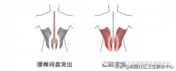 腰痛是&OpenCurlyDoubleQuote;腰椎間盤突出&rdquo;還是腰肌勞損？
