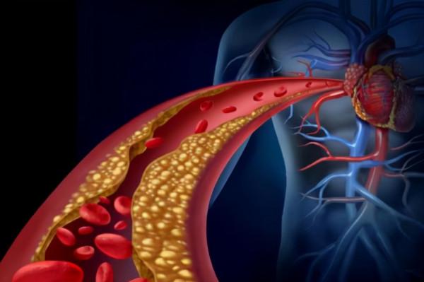 血管專家提醒：血脂超標，這幾種食物儘量要忌口，應牢記