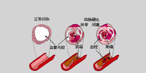 1+1＞2，冠心病這樣選擇治療方案，更有助於保護心臟