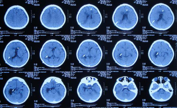 顱內生殖細胞瘤切除術後腦積水仍反覆,意識模糊,左側肢體偏癱 顱內生殖細胞瘤切除術後腦積水仍反覆,意識模糊,左側肢體偏癱