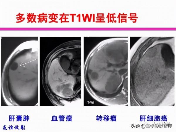 臨床MRI訊號分析基礎：常規序列及DWI序列