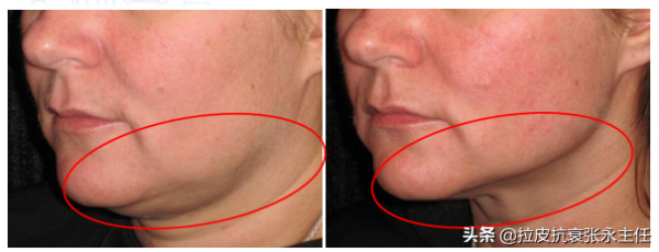 小切口拉皮除皺術真的能維持10年？