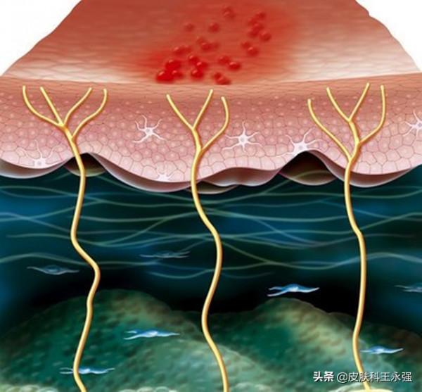 疼起來要命的“纏腰龍”，醫生：其實並不難應付，得積極就醫