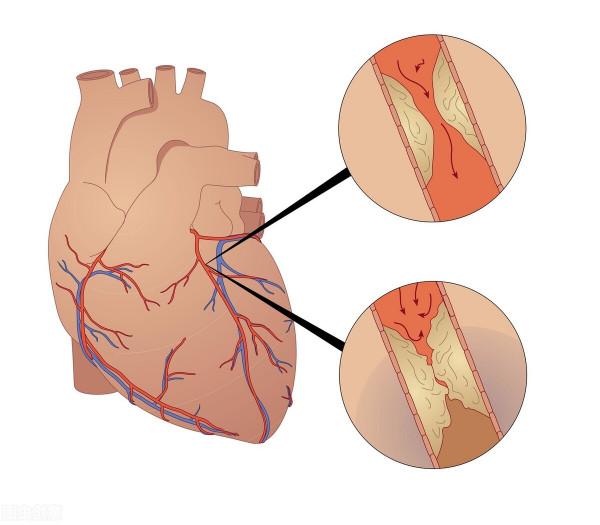 男子10天多次出現心梗先兆,可是沒有重視!最終發展為心肌梗死 男子10天多次出現心梗先兆,可是沒有重視!最終發展為心肌梗死